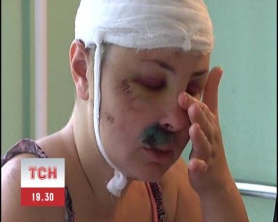 Ирина Крашкова после нападения