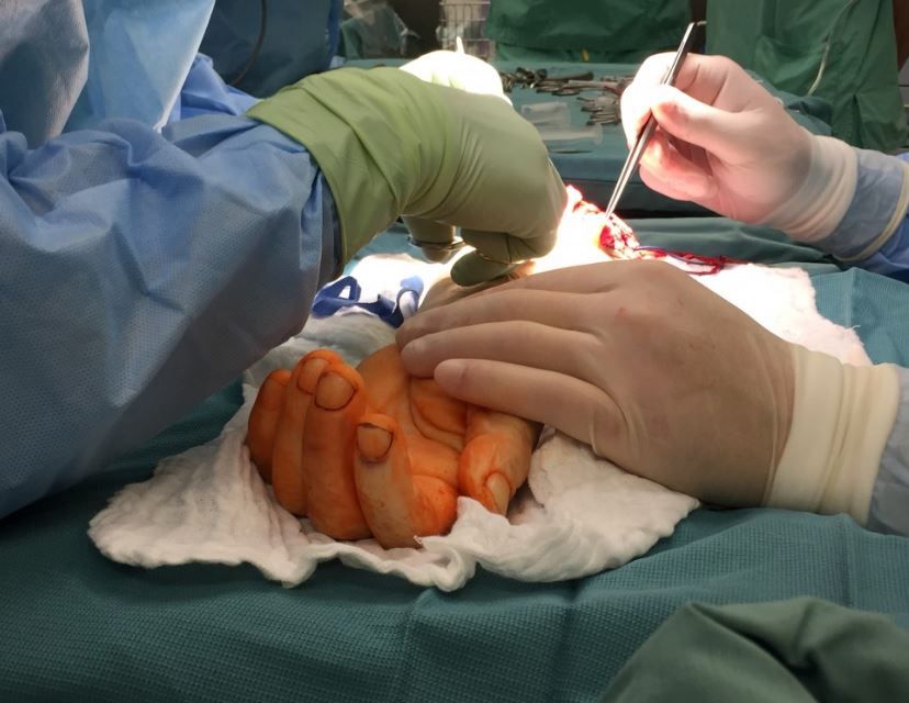 Уникальная операция польских хирургов: пересадили руку, которой у мужчины никогда не было: опубликованы фото и видео