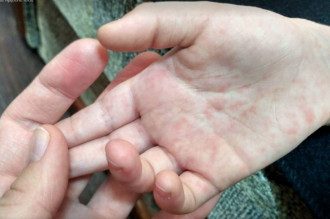 На Одесчине количество больных корью возросло почти до 60 человек
