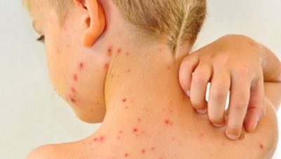 На Одесчине корью заболели почти 80 детей На Одесчине корью заболели почти 80 детей