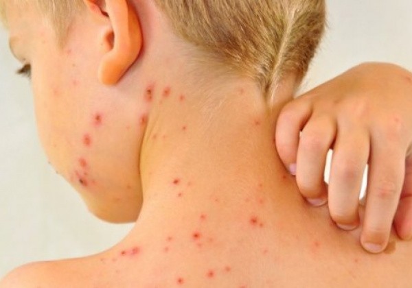Вся правда о кори в Украине 2019: как передается корь и ее симптомы