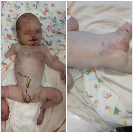 В Первомайск к больнице подкинули новорожденного с ссадинами, синяками и царапинами