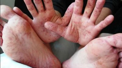 Корь стремительно распространяется в Украине