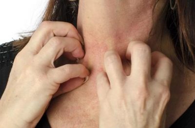 Аллергия Аллергия