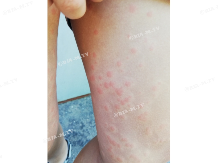 Морские блохи атакуют Кирилловку