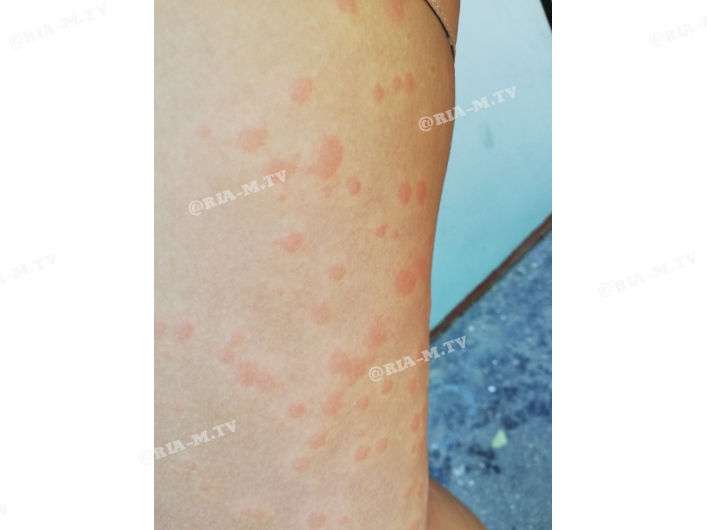 Морские блохи атакуют Кирилловку