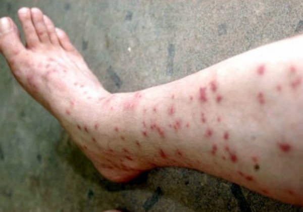 Морские блохи нападают на туристов в Кирилловке: чем опасны ненасытные паразиты