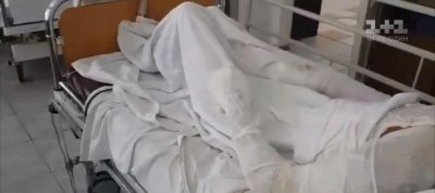 У девушки 20 процентов ожогов тела / ТСН