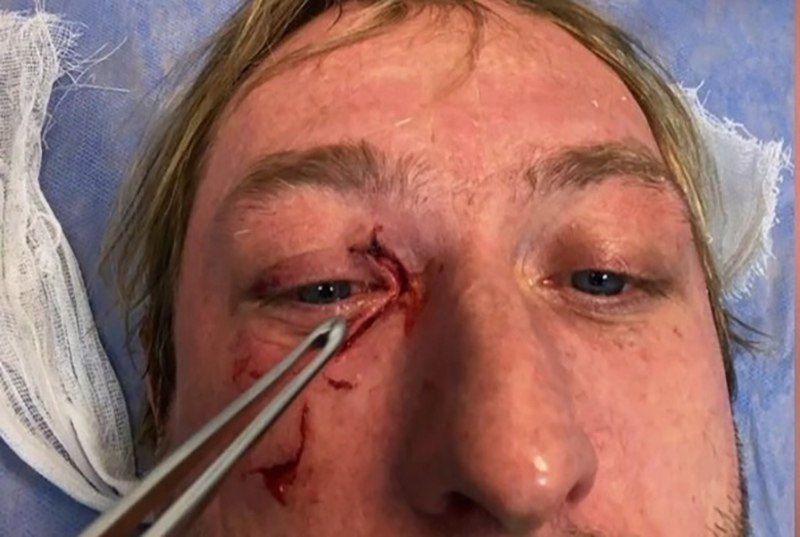 "У меня не было глаза": Евгений Плющенко получил травму на льду "У меня не было глаза": Евгений Плющенко получил травму на льду