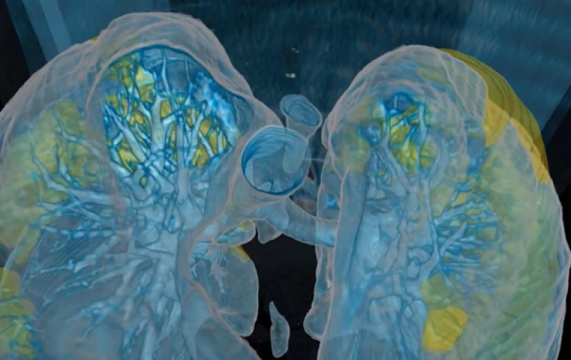 Как COVID-19 поражает легкие человека: опубликованы жуткие кадры