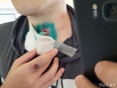 У Білорусі активісти показали вогнепальні поранення: моторошні фото