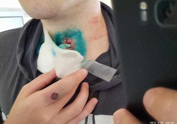 У Білорусі активісти показали вогнепальні поранення: моторошні фото