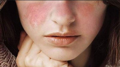 Невідомо, що викликає вовчак/Газета.ру Невідомо, що викликає вовчак/Газета.ру