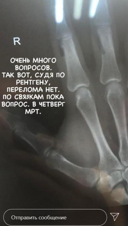 Влад Яма признался, вернется ли на Танці з зірками и показал рентген руки Влад Яма признался, вернется ли на Танці з зірками и показал рентген руки