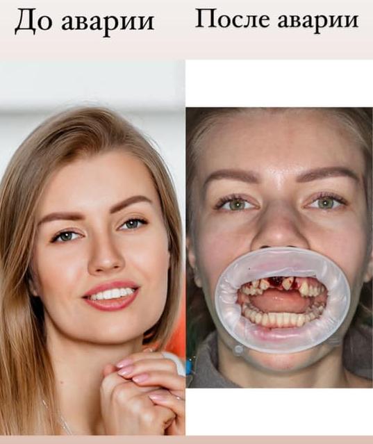 ДТП с экс-главой СЭС Киева: пострадавшая рассказала о проблемах со здоровьем после аварии