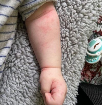 Наколота ручка: у Житомирі лікарі витикали голкою кінцівку дитині