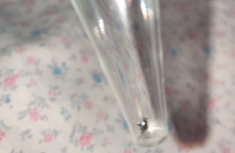 У мешканки Сумщини з-під пломби витягли небезпечного кліща У мешканки Сумщини з-під пломби витягли небезпечного кліща