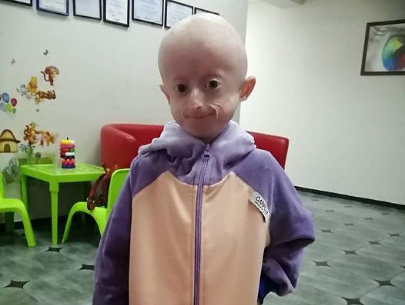 Десятирічна вінничанка померла від старості: у дівчинки була дуже рідкісна хвороба