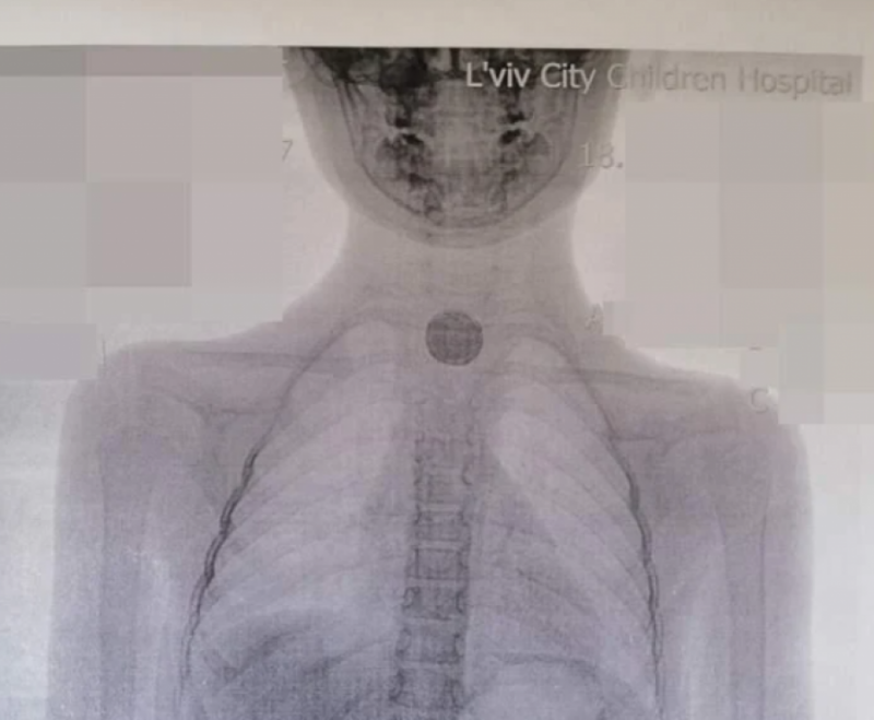 "Все чорне і обпалене": у Львові дівчинка проковтнула батарейку і сильно пошкодила стравохід