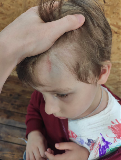 Ребенок получил перелом ключицы Ребенок получил перелом ключицы