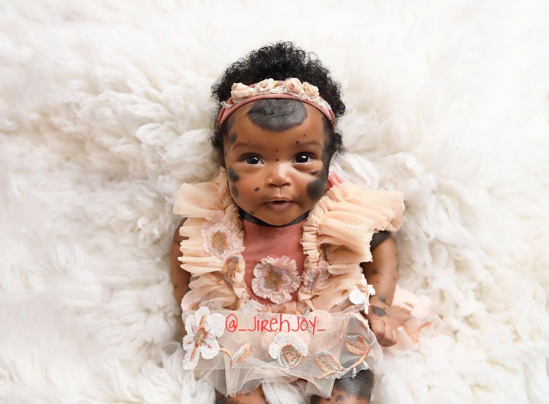 Піврічна дівчинка з унікальними темними плямами стала зіркою Instagram - щемливі фото