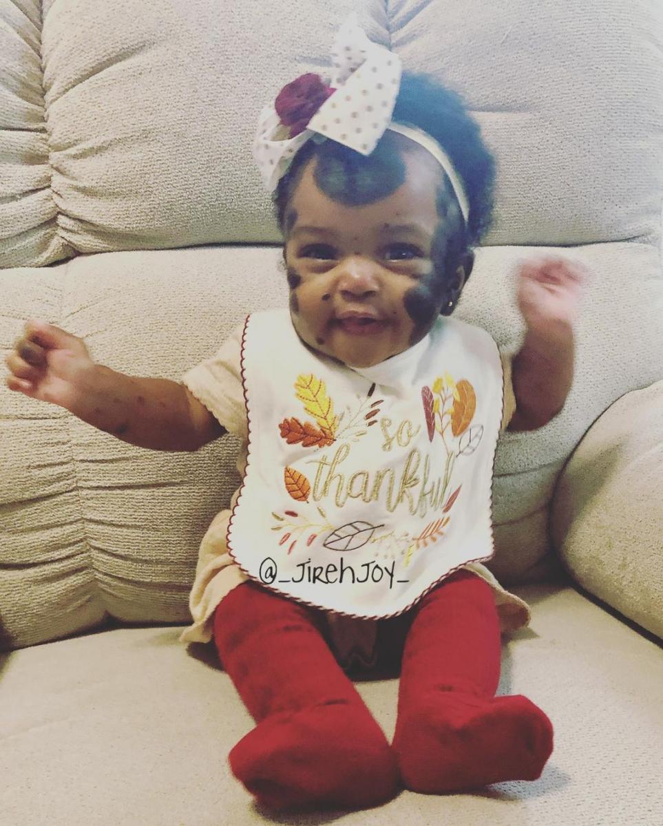 Піврічна дівчинка з унікальними темними плямами стала зіркою Instagram - щемливі фото