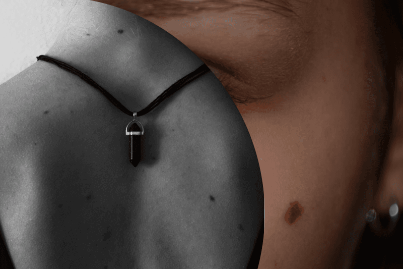 Для чого нам потрібні родимки і чому їх не можна здирати