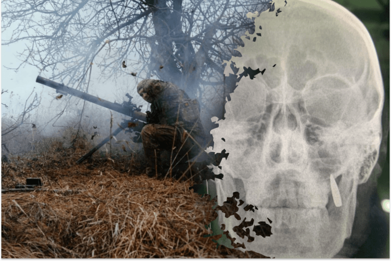 Куля застрягла у щелепі: український військовий дивом вижив, не здогадуючись про це