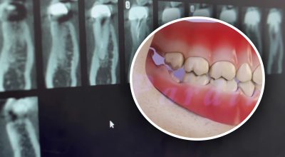 Болить зуб мудрості: симптоми, коли треба видаляти 'вісімки' Болить зуб мудрості: симптоми, коли треба видаляти 'вісімки'