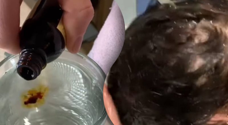 Девушка постоянно наносит йод на голову: что происходит с ее волосами