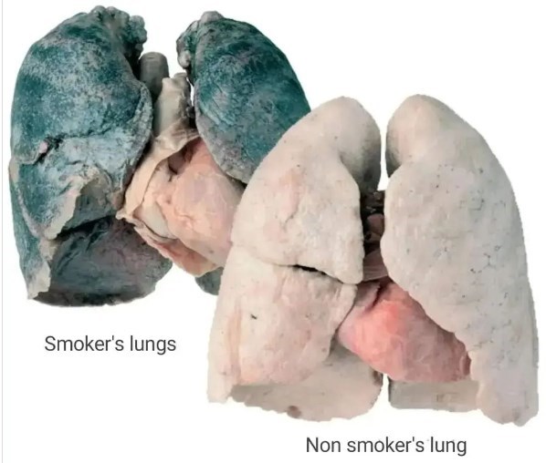 Легені курця