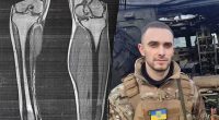 Відріж ногу - отримаєш групу: військовому відмовились давати 2 групу інвалідності
