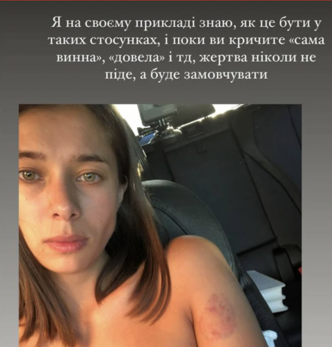 Анна Неплях показала свои синяки Анна Неплях показала свои синяки