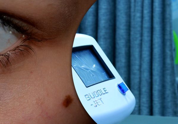 Можно ли вырывать волосы из родинки: что будет