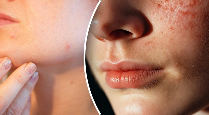 Как убрать прыщи на лице в домашних условиях: действующие советы