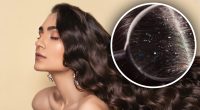 Свербить шкіра голови: лікар розкрив, чому насправді з'являється лупа