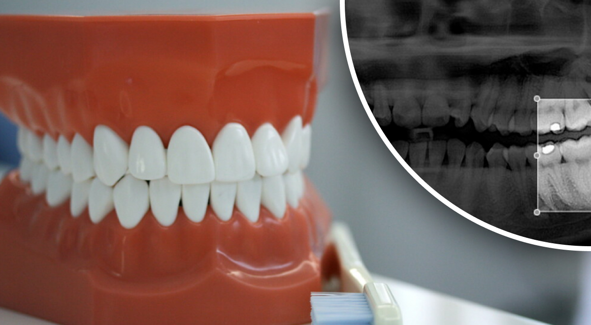 Надо ли удалять зубы мудрости - стоматолог расставил точки над 