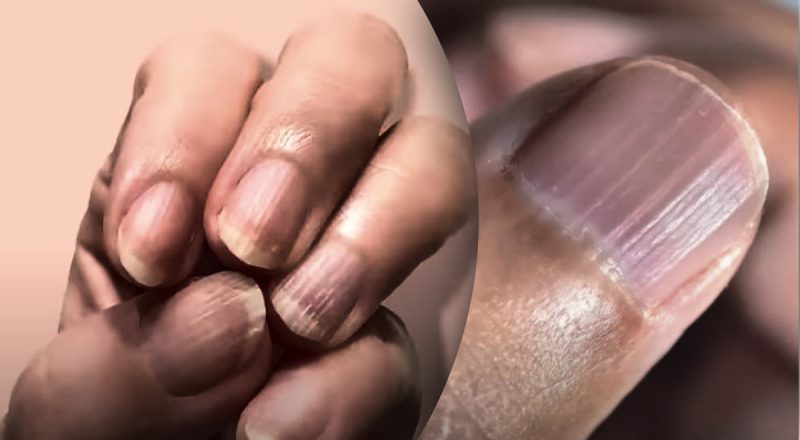 Бачили всі, але розуміють одиниці: чому нігті стають ребристими - важливий знак