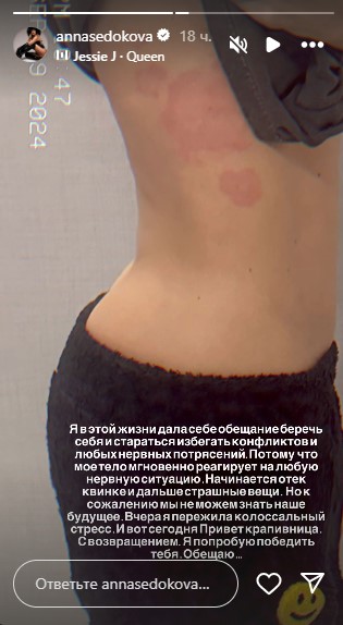 Анна Седокова показала аллергию Анна Седокова показала аллергию