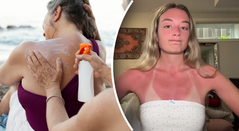 Шкіра скаже "дякую": лікарі розповіли, що робити, якщо згоріли на сонці