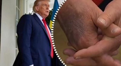 Трамп, синяки Трамп, синяки
