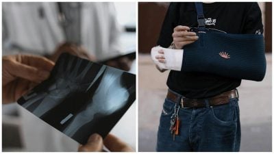 перелом перелом