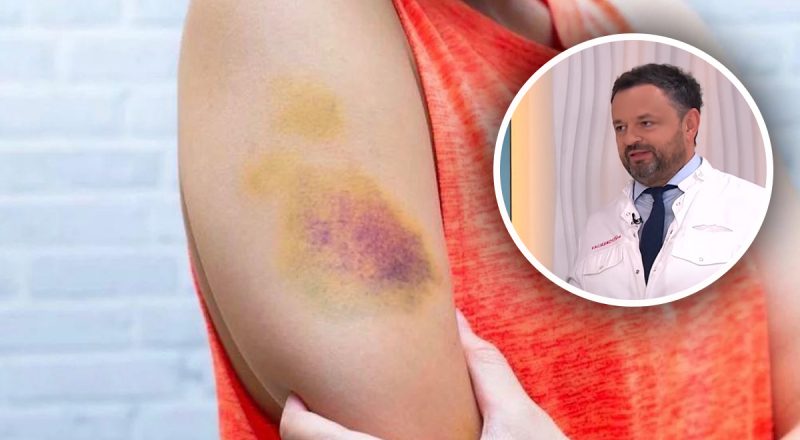 Чому на тілі з'являються синці: спеціаліст дав неочікувану відповідь
