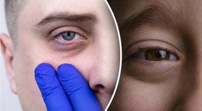 Чому з'являються мішки під очима - вчені вказали на цікавий нюанс Чому з'являються мішки під очима - вчені вказали на цікавий нюанс