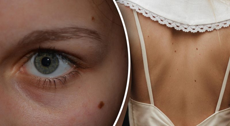 Родинки на разных частях тела и их значение: что говорят метки на коже