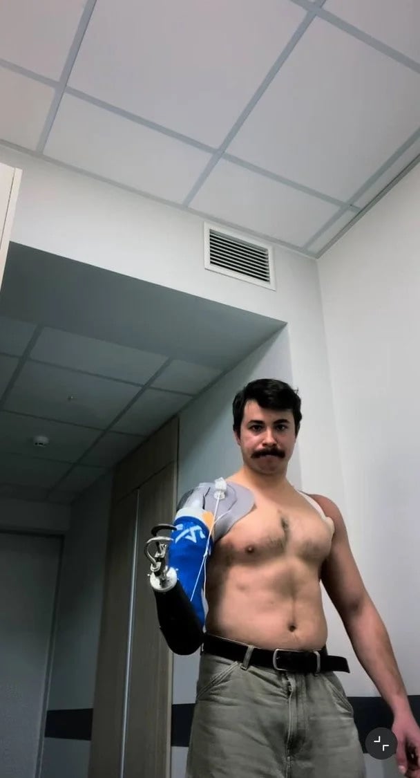 Син Грубіча з'явився з протезом 