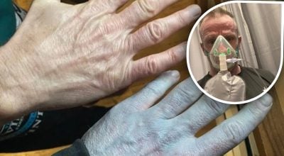 Чоловік прокинувся з синьою шкірою