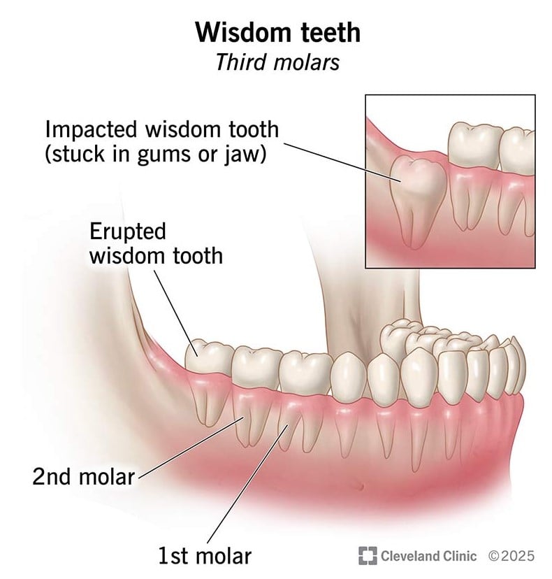 Зуби мудрості з’являються пізніше за інші