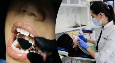 Зуби мудрості з’являються останніми, зазвичай у віці від 17 до 25 років