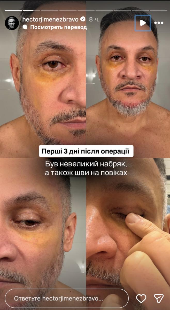 Судья Мастер Шеф показал, как выглядит после операции 